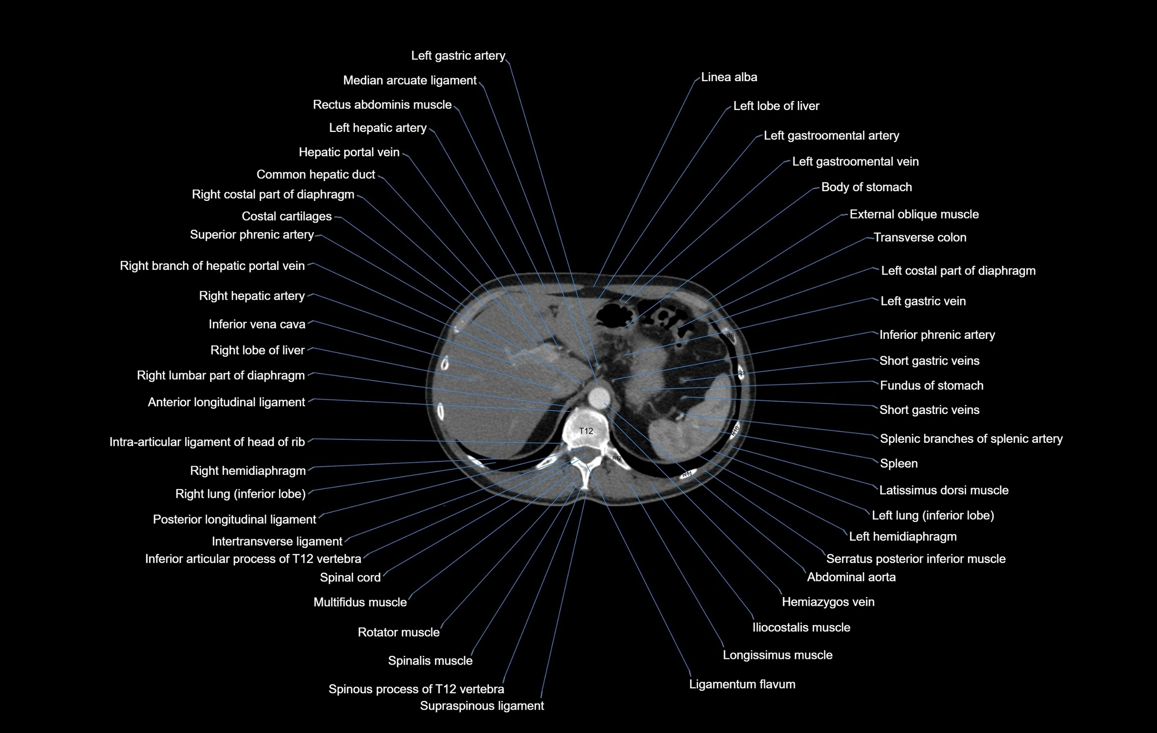 CT chest (thorax) labelled axial cross sectional anatomy radiology image-00116.webp